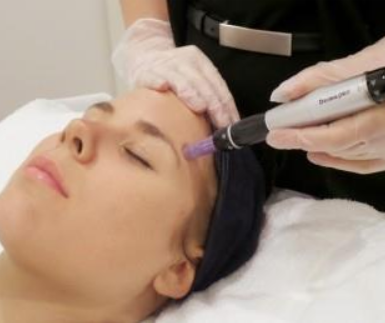 Skin Needling Facial