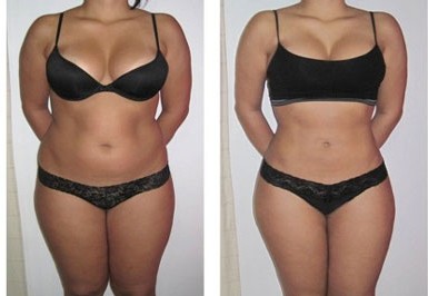 Hifu Body Fat Reduction & Cellulite Treatments