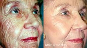 Deep Wrinkle RF & Skin Needling Facial voucher