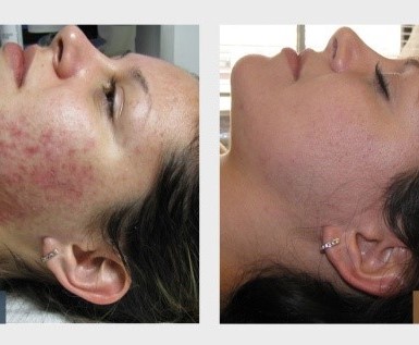 IPL Skin Rejuvenation