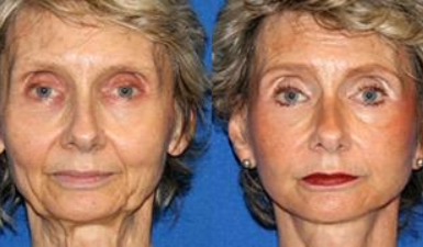 RF Face Lift Facial